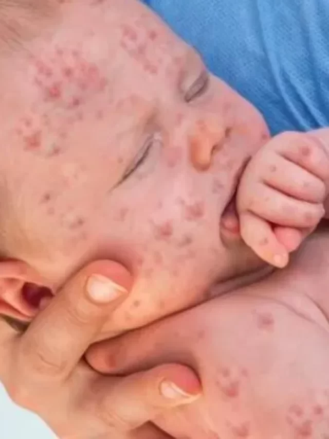 Measles Cases In Kentucky